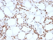 IHC: FFPE human angiosarcoma tested with anti-Histone H1 antibody (clone SPM256).