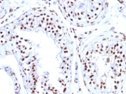 IHC: FFPE human testicular carcinoma tested with Histone H1 antibody (clone 1415-1).