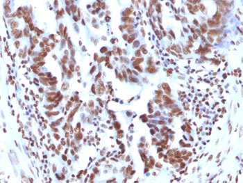 IHC: FFPE human ovarian carcinoma tested with Histone H1 antibody (1415-1)