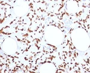 IHC: FFPE human angiosarcoma tested with Histone H1 antibody (1415-1)