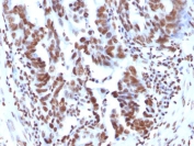 IHC: FFPE human ovarian carcinoma tested with Histone H1 antibody (clone 1415-1).