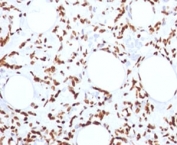 IHC: FFPE human angiosarcoma tested with Histone H1 antibody (clone 1415-1).