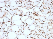IHC: FFPE human angiosarcoma tested with Histone H1 antibody (clone HH1/957).