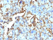 IHC: Formalin-fixed, paraffin-embedded human Histiocytoma stained with HLA-DRB antibody (clone HLA-DRB/1067).