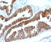 IHC: Formalin-fixed, paraffin-embedded human prostate carcinoma stained with HSP27 antibody (clone HSPB1/774).