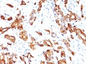 IHC: Formalin-fixed, paraffin-embedded human breast carcinoma stained with HSP27 antibody (clone HSPB1/774).
