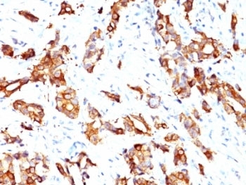 IHC: Formalin-fixed, paraffin-embedded human breast carcinoma stained with HSP27 antibody (clone HSPB1/774).~