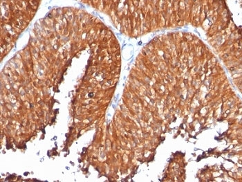 Formalin-fixed, paraffin-embedded human bladder carcinoma stained with anti-HSP60 antibody (clone SPM253).~