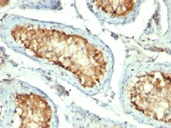 IHC testing of FFPE human testicular carcinoma with HSP60 antibody (clone GROEL/730).~