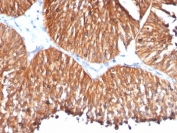 IHC: Formalin-fixed, paraffin-embedded human bladder carcinoma stained with HSP60 antibody (clone HSPD1/780).