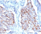 IHC: Formalin-fixed, paraffin-embedded human lung carcinoma stained with HSP60 antibody (clone HSPD1/780).