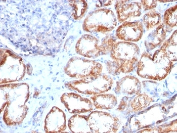 IHC: Formalin-fixed, paraffin-embedded human renal cell carcinoma stained with HSP60 antibody (clone HSPD1/780).~