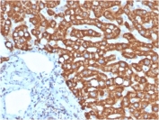 IHC staining of FFPE human liver cancer metastasis  in colon tissue with HSP60 antibody (clone HSPD1/875). HIER: boil tissue sections in pH 9 10mM Tris with 1mM EDTA for 20 min and allow to cool before testing.