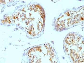 IHC: Formalin-fixed, paraffin-embedded human testicular carcinoma stained with Perlecan antibody (A7L6).~