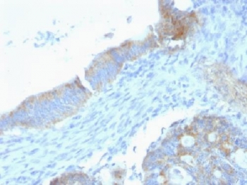 IHC: Formalin-fixed, paraffin-embedded human testicular carcinoma stained with anti-Perlecan antibody (clone SPM255).~