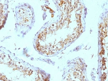 IHC testing of FFPE human testicular carcinoma tissue with Perlecan antibody (clone SPM255).