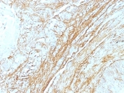 IHC: Formalin-fixed, paraffin-embedded human lung carcinoma stained with Tenascin C antibody (T2H5) at 4ug/ml. Antigen retrieval in 10mM Tris with 1mM EDTA, pH 9.0; ABC detection system with DAB Chromogen. Note staining of connective tissue.