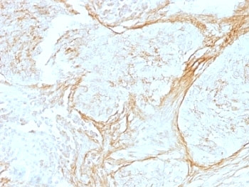 IHC: Formalin-fixed, paraffin-embedded human lung carcinoma stained with anti-Tenascin C antibody (clone SPM319) at 4ug/ml.~