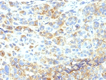 IHC analysis of formalin-fixed, paraffin-embedded human melanoma stained with ICAM-1 antibody (clone 1H4).~