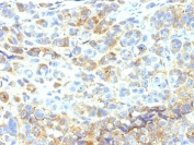 IHC analysis of formalin-fixed, paraffin-embedded human melanoma stained with ICAM-1 antibody (clone 1H4).