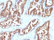 IHC: Formalin-fixed, paraffin-embedded human prostate carcinoma stained with IDH1 antibody (clone IDH1/1152).