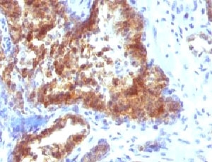 IHC: Formalin-fixed, paraffin-embedded human prostate carcinoma stained with Prostate Specific antibody (clone KLK3/1248).~