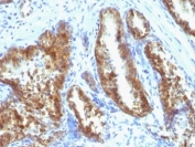 IHC: Formalin-fixed, paraffin-embedded human prostate carcinoma stained with Prostate Specific Antigen antibody (A67-B/E3 + 1A7).