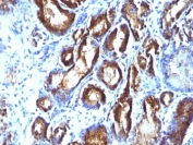 IHC: Formalin-fixed, paraffin-embedded human prostate carcinoma stained with PSA antibody (KLK3/801 + KLK3/1248).