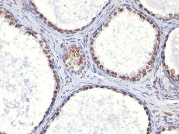 IHC: Formalin-fixed, paraffin-embedded human prostate carcinoma stained with AR antibody (AR441).