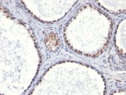IHC: Formalin-fixed, paraffin-embedded human prostate carcinoma stained with AR antibody (AR441).