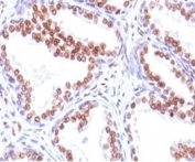 IHC: Formalin-fixed, paraffin-embedded human prostate carcinoma stained with anti-Androgen Receptor antibody (SPM335).