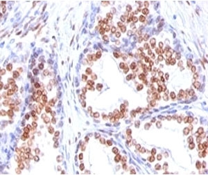 IHC: Formalin-fixed, paraffin-embedded human prostate carcinoma stained with Androgen Receptor antibody (DHTR/882).~
