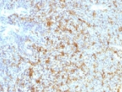 IHC testing of FFPE human follicular lymphoma with CD11c antibody (clone ITGAX/1243). Note staining of cancer cells. Required HIER: boil tissue sections in 10mM Tris with 1mM EDTA, pH 9.0, for 10-20 min.