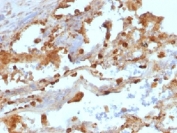 IHC testing of FFPE human lung carcinoma with CD11c antibody (clone ITGAX/1243). Note staining of cancer cells. Required HIER: boil tissue sections in 10mM Tris with 1mM EDTA, pH 9.0, for 10-20 min.