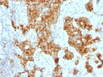 IHC testing of FFPE human prostate carcinoma with CD11c antibody (clone ITGAX/1243). <I>Note staining of cancer cells.</i> Required HIER: boil tissue sections in 10mM Tris with 1mM EDTA, pH 9.0, for 10-20 min.~