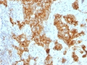 IHC testing of FFPE human prostate carcinoma with CD11c antibody (clone ITGAX/1243). Note staining of cancer cells. Required HIER: boil tissue sections in 10mM Tris with 1mM EDTA, pH 9.0, for 10-20 min.