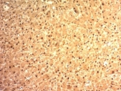 IHC: Formalin-fixed, paraffin-embedded human hepatocellular carcinoma stained with Arginase 1 antibody (ARG1/1125). HIER: boil tissue sections in pH 9 10mM Tris with 1mM EDTA for 10-20 min followed by cooling at RT prior to testing.