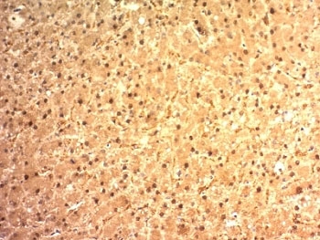 IHC: Formalin-fixed, paraffin-embedded human hepatocellular carcinoma stained with Arginase 1 antibody (ARG1/1125). HIER: boil tissue sections in pH 9 10mM Tris with 1mM EDTA for 10-20 min followed by cooling at RT prior to testing.~