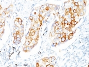 IHC: Formalin-fixed, paraffin-embedded human lung SCC stained with Cytokeratin 7 antibody (clone OV-TL12/30). HIER: boil tissue sections in pH6, 10mM citrate buffer, for 10-20 min and allow to cool before testing.