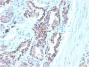IHC staining of FFPE human prostate carcinoma with Cytokeratin 7 antibody (clone OV-TL12/30). HIER: boil tissue sections in pH 9 10mM Tris with 1mM EDTA for 20 min and allow to cool before testing.
