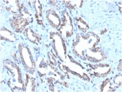 IHC staining of FFPE human prostate carcinoma with Cytokeratin 7 antibody (clone OV-TL12/30). HIER: boil tissue sections in pH 9 10mM Tris with 1mM EDTA for 20 min and allow to cool before testing.