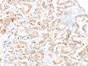 IHC: Formalin-fixed, paraffin-embedded human lung SCC stained with Keratin 7 antibody (clone SPM270).