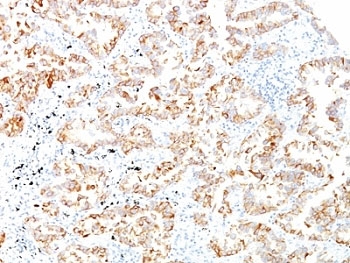 IHC: Formalin-fixed, paraffin-embedded human lung SCC stained with Keratin 7 antibody (clone SPM2