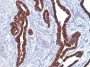 IHC: Formalin-fixed, paraffin-embedded ovarian carcinoma stained with Keratin 7 antibody (clone K72.7).