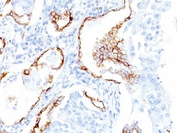 IHC: Formalin-fixed, paraffin-embedded human lung SCC stained with Keratin 7 antibody (clone K72.7).~