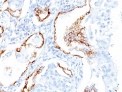IHC: Formalin-fixed, paraffin-embedded human lung SCC stained with Keratin 7 antibody (clone K72.7).