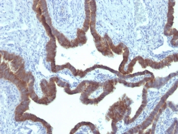 IHC: Formalin-fixed, paraffin-embedded human ovarian carcinoma stained with Cytokeratin 7 antibody (clone KRT7/903).~