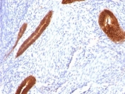 IHC: Formalin-fixed, paraffin-embedded human endometrial carcinoma stained with Cytokeratin 7 antibody (clone KRT7/760).