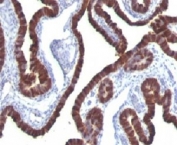 IHC: Formalin-fixed, paraffin-embedded human ovarian carcinoma stained with Cytokeratin 7 antibody (clone KRT7/760).