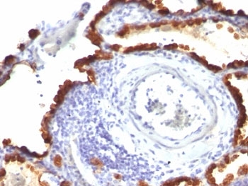 IHC: Formalin-fixed, paraffin-embedded human lung carcinoma stained with Keratin 7 antibody (KRT7/760 + KRT7/903)~